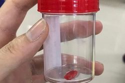 Bé 2 tuổi tím tái vì vừa khóc, vừa ăn