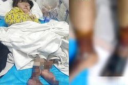 Bé gái 4 tuổi bị dì ghẻ bạo hành, dùng kim châm vào cơ thể, rót nước sôi vào người gây chấn động TQ