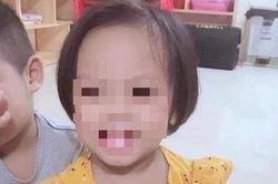 Sức khỏe bé 3 tuổi nghi bị bạo hành với 9 chiếc đinh ghim ở đầu hiện như thế nào?