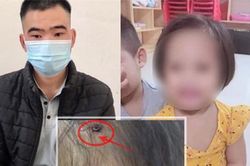 Hà Nội yêu cầu xử lý nghiêm vụ cháu bé bị đóng đinh vào đầu