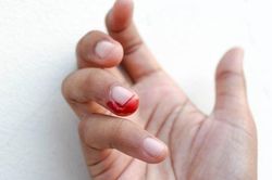 Vết cắn trên ngón tay vạch tội ác của kẻ giết bà bầu ở Mỹ