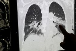 Phát hiện mới về nguyên nhân, cơ chế gây hội chứng COVID kéo dài