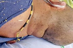 Cứu sống người đàn ông bị ong đốt hàng trăm mũi