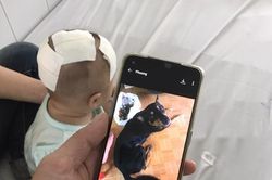 Bé gái 6 tháng tuổi bị chó nhà cắn chấn thương sọ não