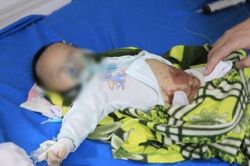 Trẻ 2 tháng tuổi co giật, tím tái do đắp tỏi điều trị COVID-19