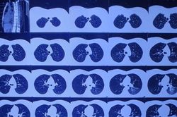 Nhiều bệnh nhân tổn thương phổi sau khi đã điều trị khỏi Covid-19