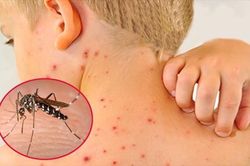 Các dấu hiệu nhận biết bệnh sốt xuất huyết