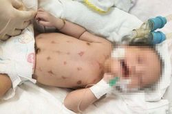 Bé sơ sinh nguy kịch sau khi nằm than, chích sài đẹn
