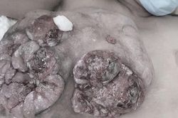 Trì hoãn điều trị để sinh con, người mẹ mất một bên ngực