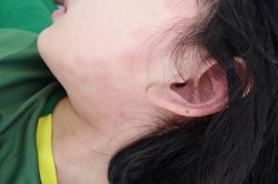 Hai trẻ nhỏ ở Hạ Long mắc hội chứng hiếm gặp hậu Covid-19