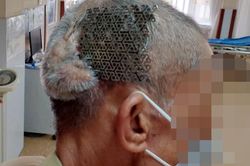 Bệnh nhân nhập viện với tấm Titatium hở trên sọ não