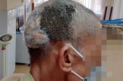 Hi hữu: Người đàn ông nhập viện với tấm Titanium hở trên sọ não