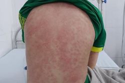 Liên tiếp nhiều trẻ mắc hội chứng viêm đa hệ thống hậu COVID-19