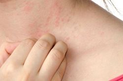 Vì sao chúng ta bị dị ứng thời tiết?