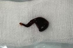 Phát hiện đỉa khủng dài 5 cm trong mũi nam bệnh nhân