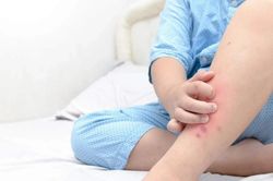 Dấu hiệu trên da cảnh báo di chứng hậu Covid-19 ở trẻ