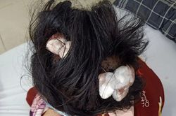 Thiếu nữ 16 tuổi bị cha dượng đánh dập lá lách, gãy xương sườn