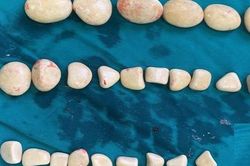 Kinh hãi 'ổ sỏi' lấp đầy trong bàng quang nam bệnh nhân