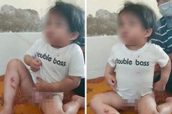 Bé 4 tuổi nhập viện với nhiều vết thương, nghi bị người nhà đánh