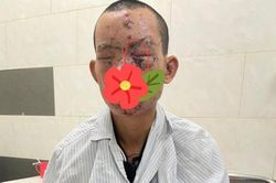 Cháy toàn thân, nguy cơ mù mắt vì xem điện thoại khi đang sạc