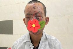 Cháy sém toàn thân, nguy cơ mù do nổ điện thoại