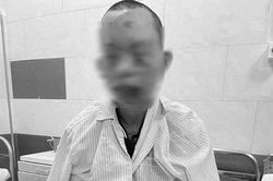 Dùng điện thoại khi đang sạc, nam thanh niên bị cháy toàn thân