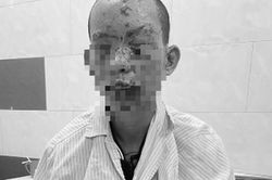 Mất thị lực, cháy sém toàn thân do dùng điện thoại đang sạc
