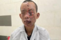 Vừa chơi điện thoại vừa sạc khiến vật phát nổ, nam thanh niên phải trả giá quá đắt khi mới 23 tuổi