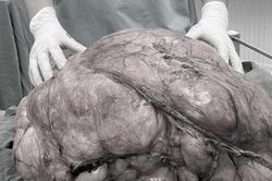 Người đàn ông ở TPHCM mang 'bụng bầu' nặng gần 18kg
