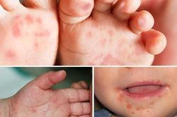TP.HCM: Bệnh tay chân miệng có xu hướng gia tăng
