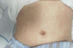 Bé gái nguy kịch sau 2 tuần mắc COVID-19
