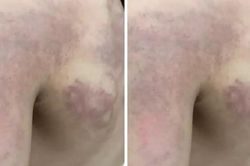 Phụ huynh tố giáo viên đánh bầm tím vai học sinh lớp 3