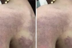 Làm rõ thông tin bé gái lớp 3 'bị giáo viên đánh bầm tím người'