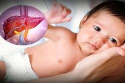 Cảnh giác với bệnh viêm gan 'bí ẩn' ở trẻ em