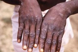 Mỹ phát hiện ca mắc bệnh đậu mùa khỉ hiếm gặp