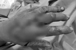 Người đàn ông đến bệnh viện với các ngón tay đứt lìa