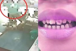 Giáo viên mầm non dùng thìa đánh nứt răng cửa của bé trai 4 tuổi