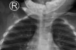 Ruột non bệnh nhi thủng 5 lỗ vì món đồ chơi nguy hiểm