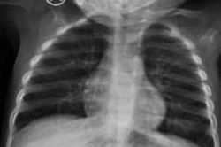 Bé 2 tuổi bị thủng 5 lỗ ở ruột non vì món đồ chơi quen thuộc