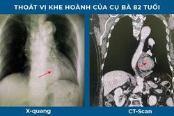 Bệnh nhân thoát vị khe hành bị chẩn đoán nhầm là suy tim suốt 10 năm