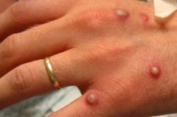 WHO: Chưa cần tiêm đại trà vaccine ngừa bệnh đậu mùa khỉ