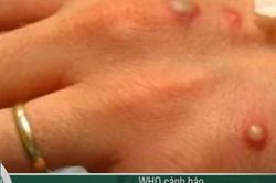 6 hiểu nhầm phổ biến về bệnh đậu mùa khỉ