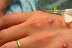 EU quyết định mua vaccine và thuốc kháng virus điều trị bệnh đậu mùa khỉ