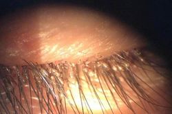 Gần 100 con rận mu làm tổ trên mi mắt người đàn ông