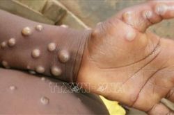 Virus gây bệnh đậu mùa khỉ tiếp tục lây lan