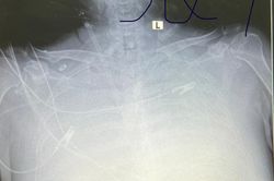 Tử vong sau khi ăn đặc sản mối rang