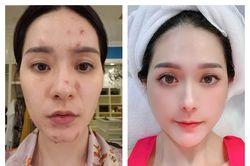 Lộ gương mặt chi chít lỗ 'nữ đại gia quận 7' làm netizen sợ