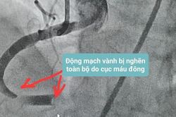 Cứu sống bệnh nhân 72 tuổi lên cơn nhồi máu cơ tim và ngưng tim