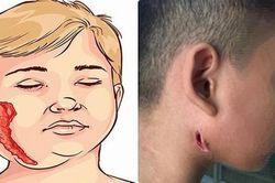 Phát hiện bé gái 9 tuổi mắc bệnh 'vi khuẩn ăn thịt người'
