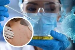 Người mắc bệnh đậu mùa khỉ tại TP.HCM sẽ được điều trị như thế nào?